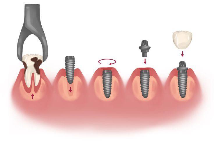 Follow-up after implants
