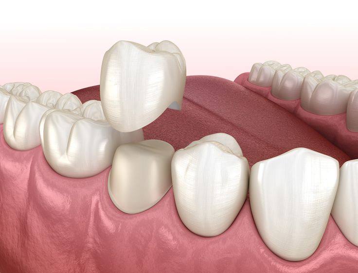 Follow-up after implants