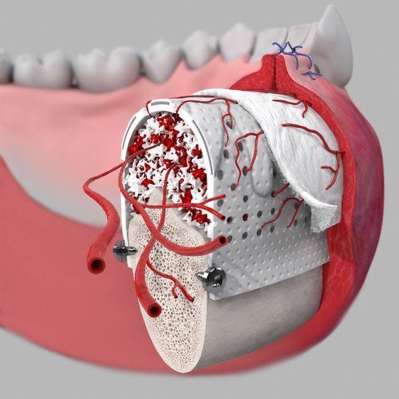 gum-repair-after-implants