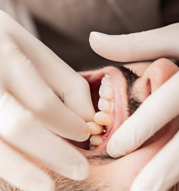 gum-repair-after-implants