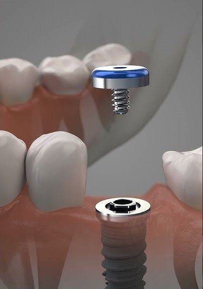 gum-repair-after-implants