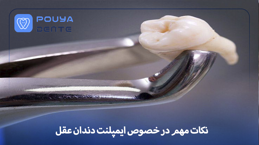 Wisdom tooth implant