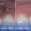 Blackening of gums after implants