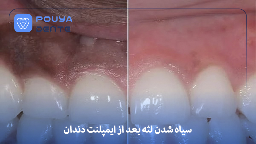 Blackening of gums after implants