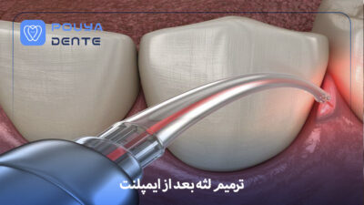 gum-repair-after-implants