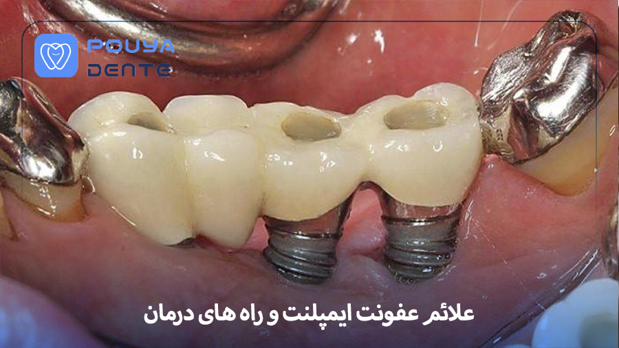 implant-infection