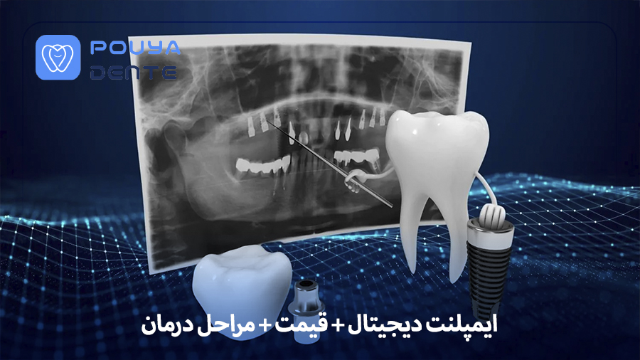ایمپلنت دیجیتال + قیمت + مراحل درمان