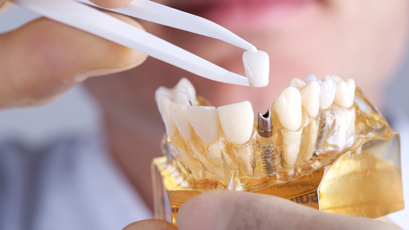 dental Implant for children