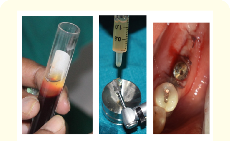 PRF in implants