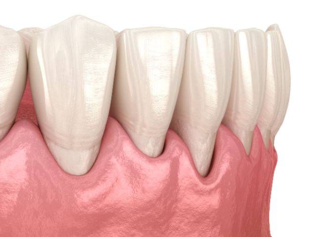 difference-between-healing-and-abutment