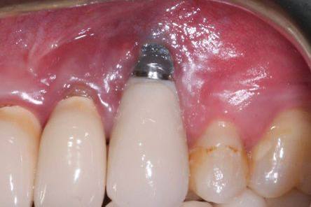 difference-between-healing-and-abutment