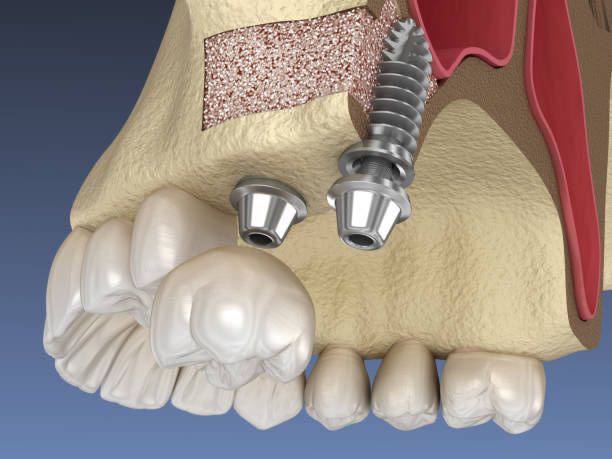 Pelvic bone grafting in implants