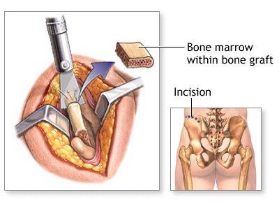 Pelvic bone grafting in implants