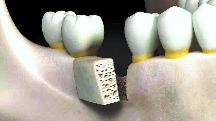 Pelvic bone grafting in implants
