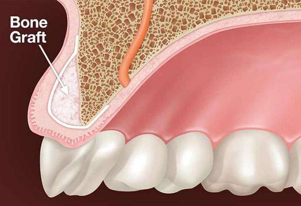 Full implant treatment