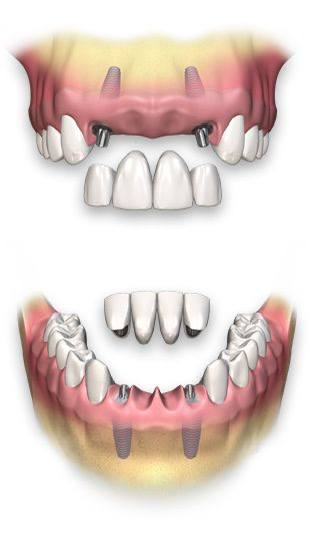 Overdenture treatment