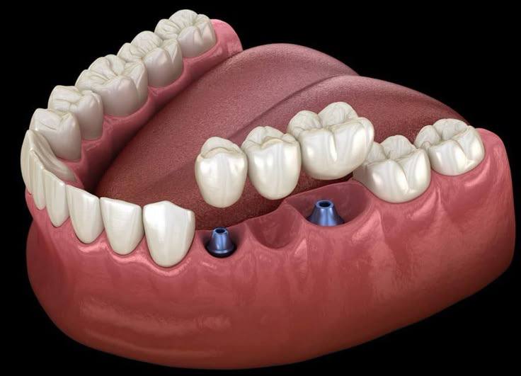 Overdenture treatment