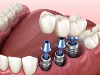 Gum problems in implants