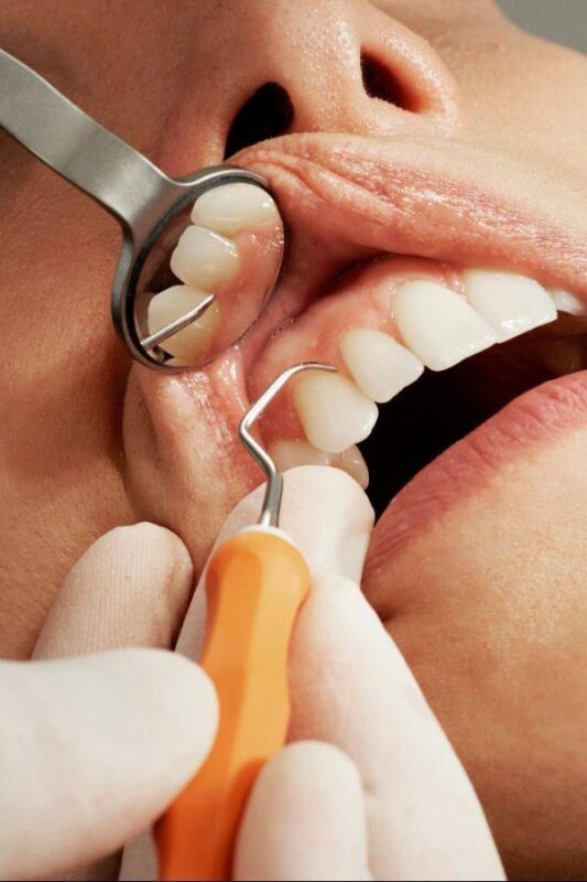 Gum problems in implants