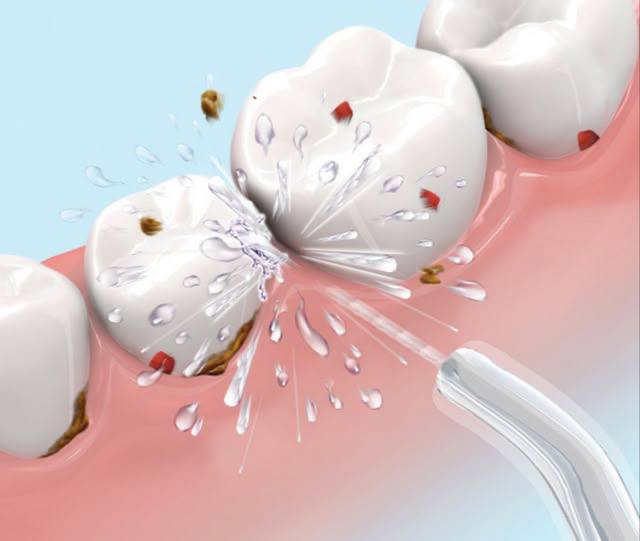 Gum problems in implants
