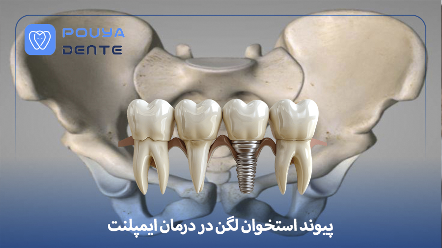 Pelvic bone grafting in implants