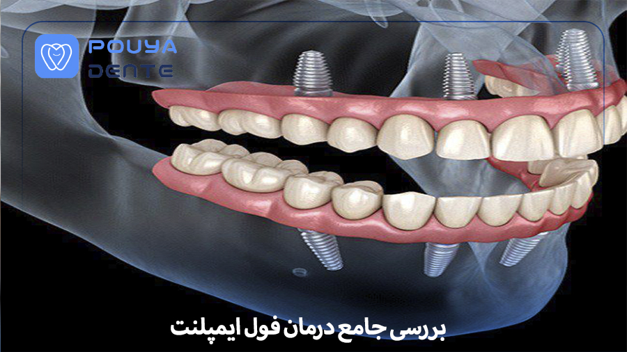 Full implant treatment