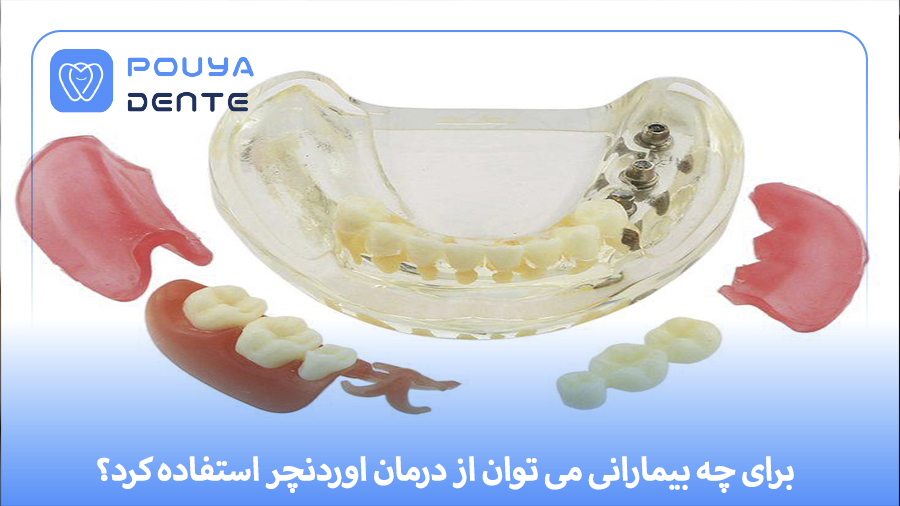 Overdenture treatment
