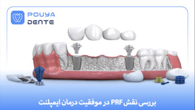 PRF in implants