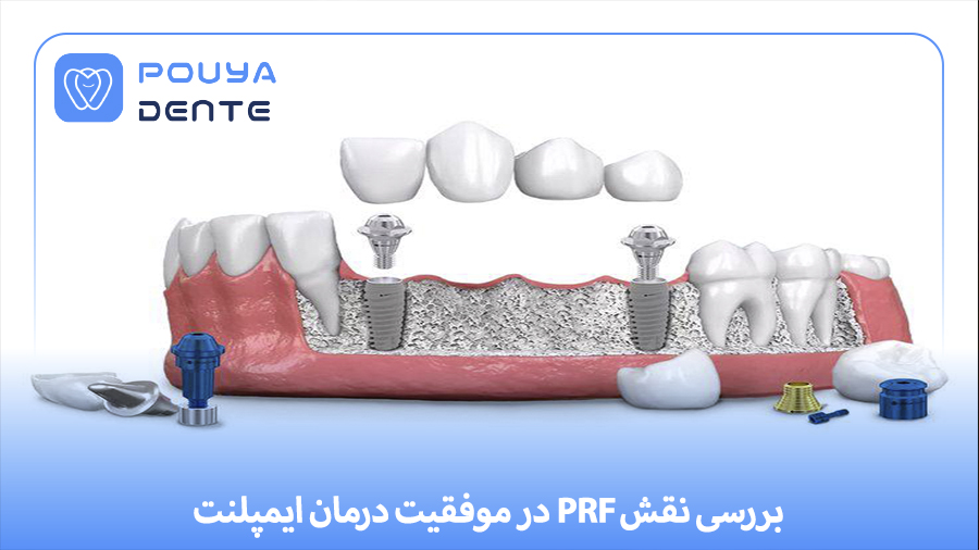 PRF in implants