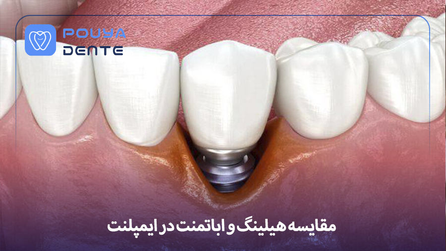 difference-between-healing-and-abutment