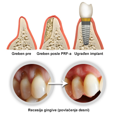 PRF in implants