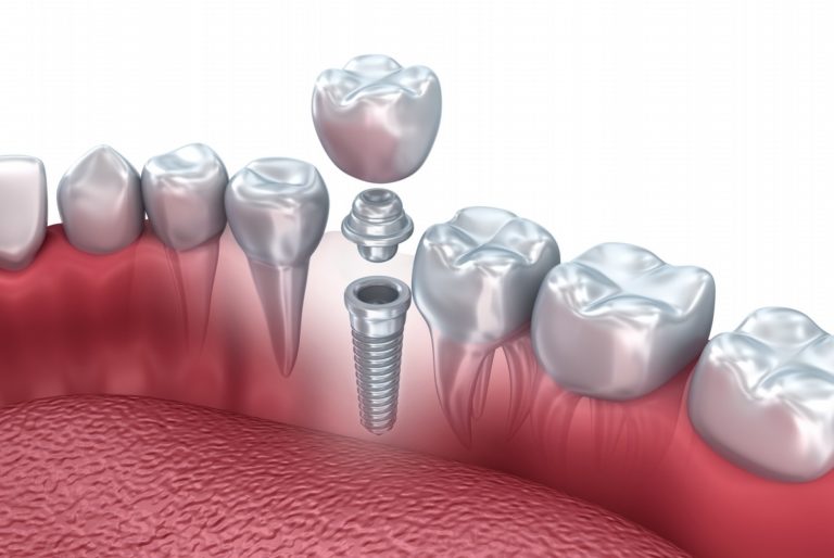 Implant and orthodontic treatment