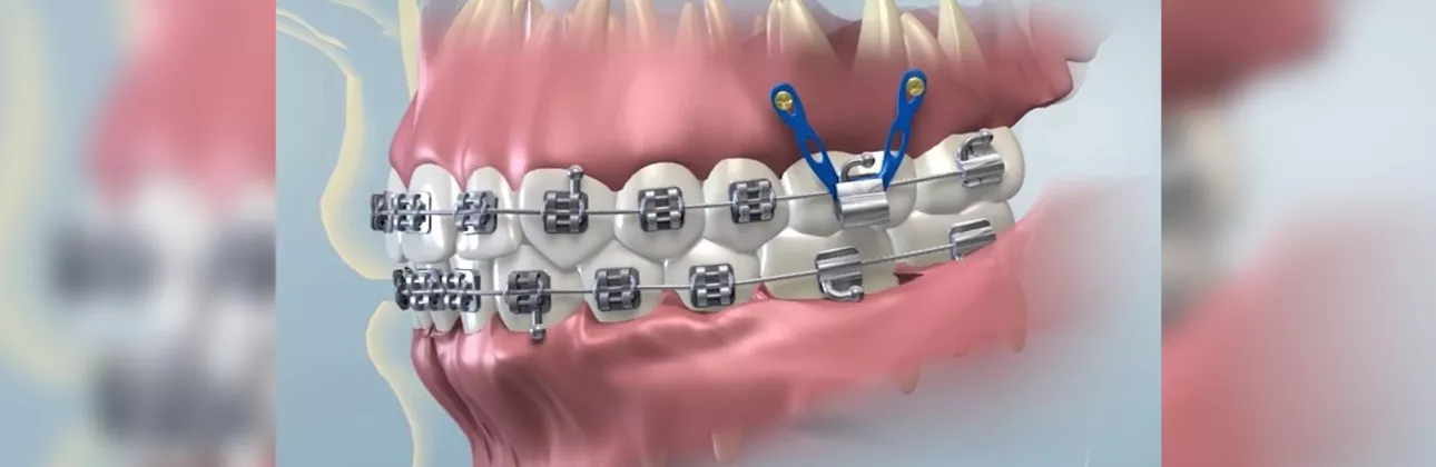 Implant and orthodontic treatment
