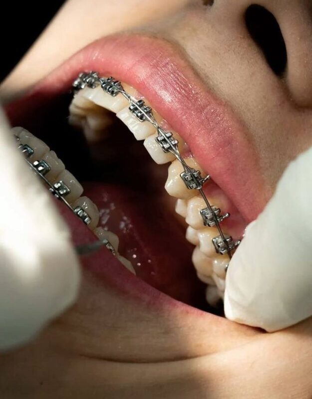 Implant and orthodontic treatment