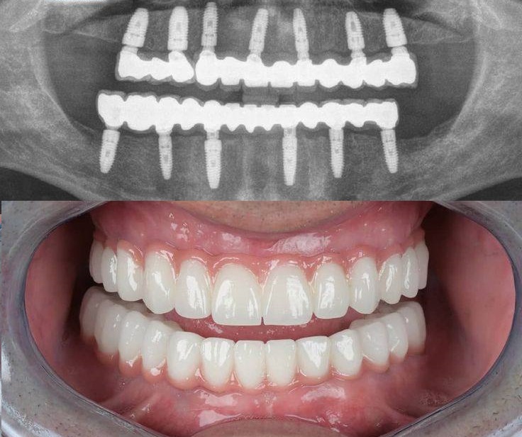difference between All on 4 and All on 6 techniques