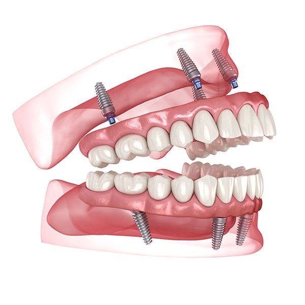 difference between All on 4 and All on 6 techniques