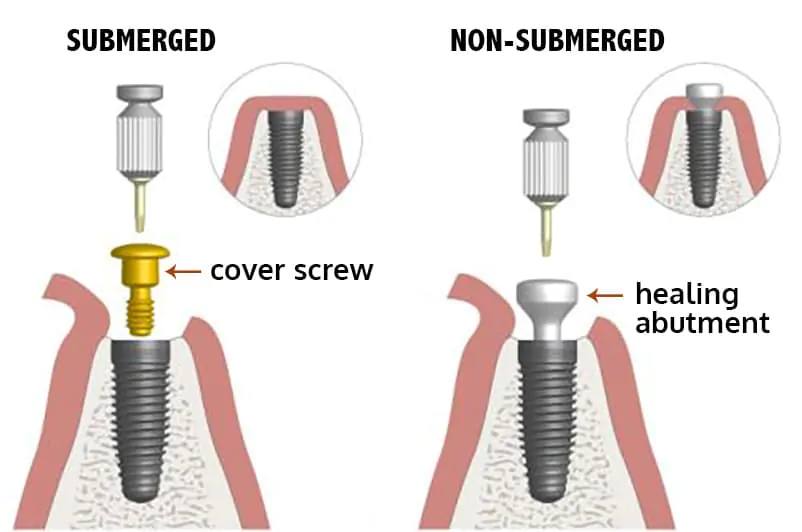Coverscrew