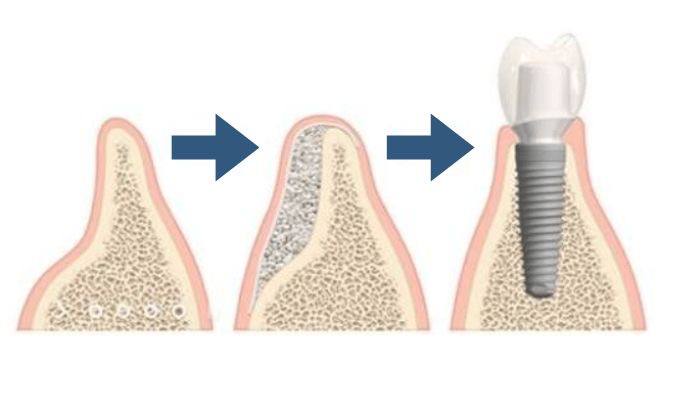 Implant lifespan