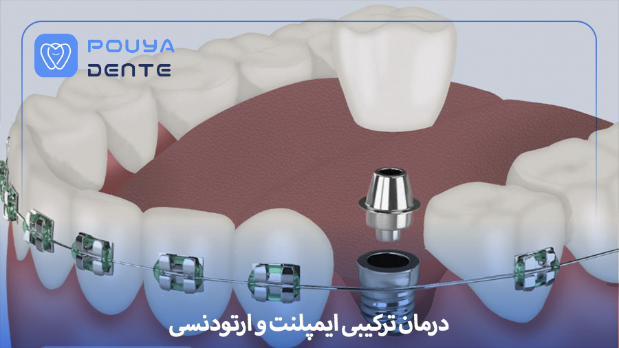 Implant and orthodontic treatment