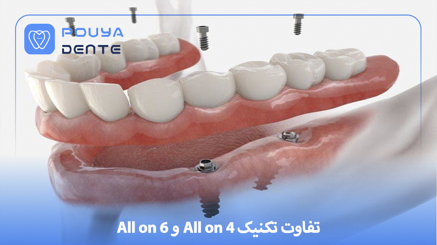 difference between All on 4 and All on 6 techniques