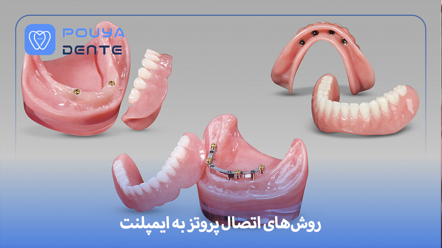 connecting-the-prosthesis-to-the-implant
