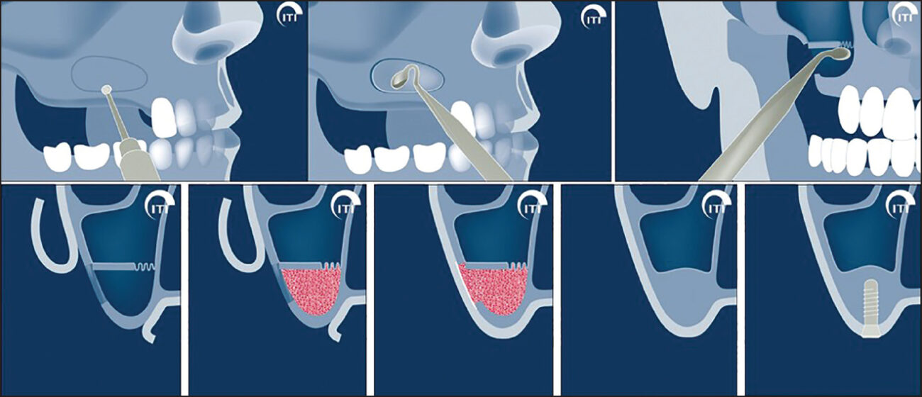 Sinus lift with implants