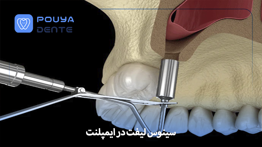 Sinus lift with implants