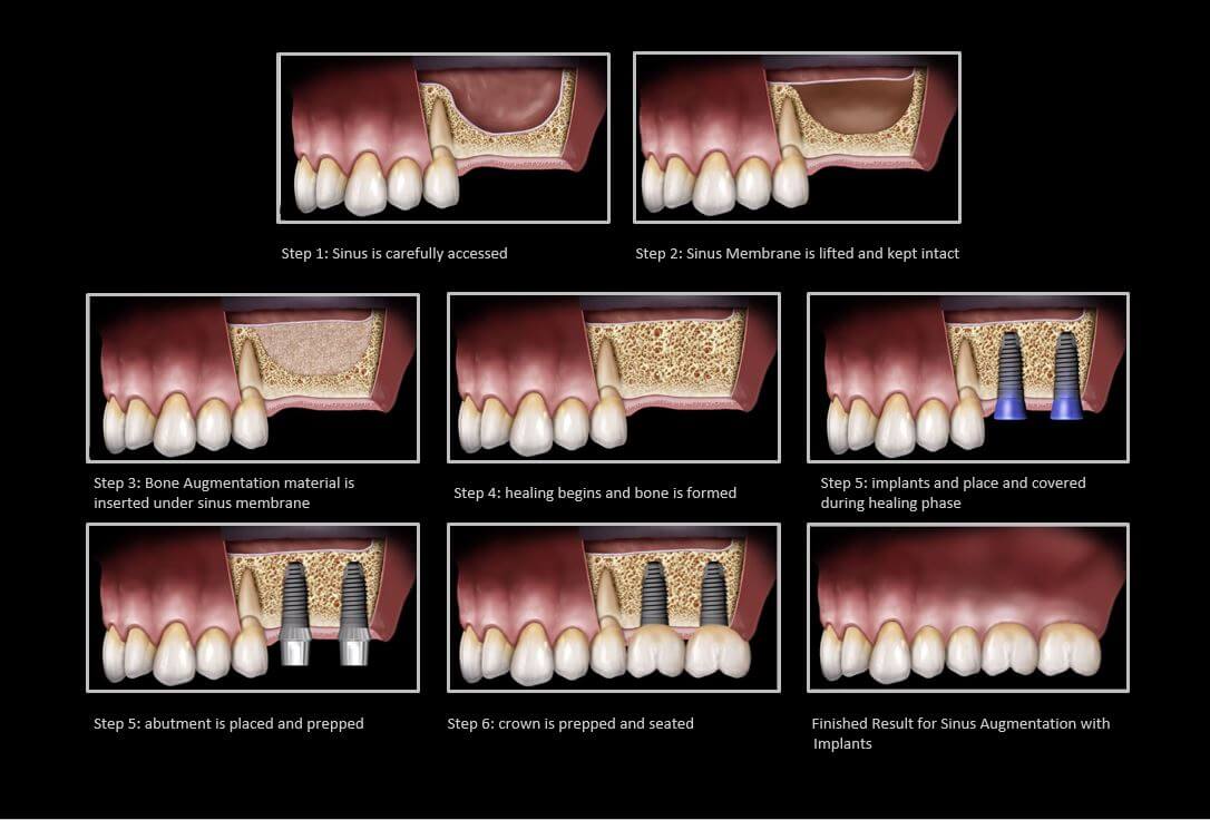 Sinus lift with implants