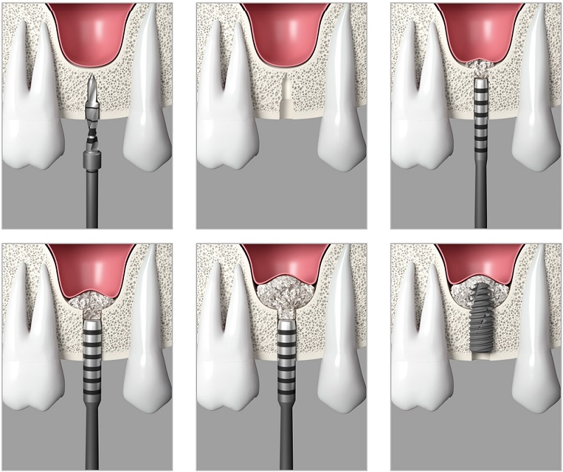 Sinus lift with implants