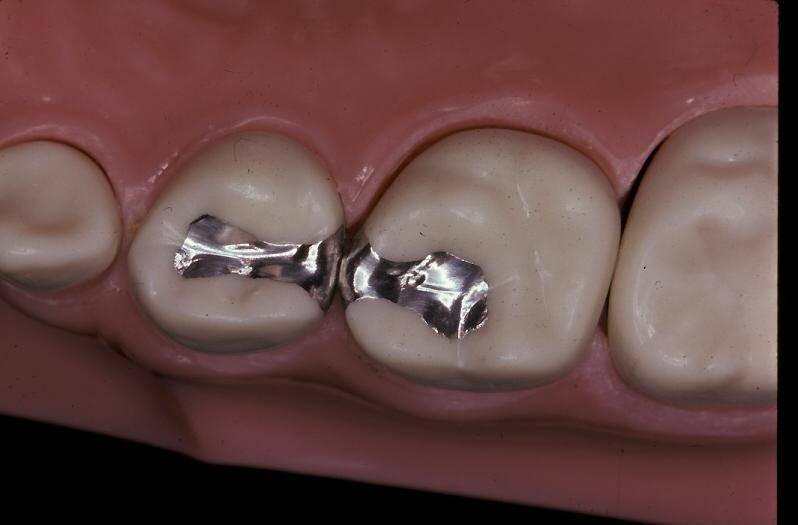 کامپوزیت دندان کودکان