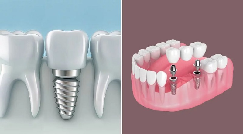 Implant replacement