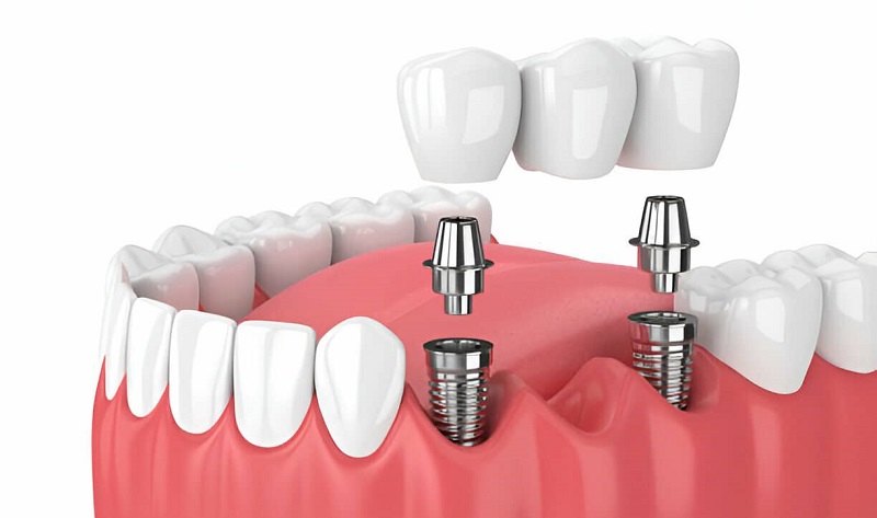 Implant replacement