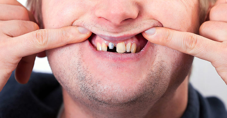 Implant crown falling off