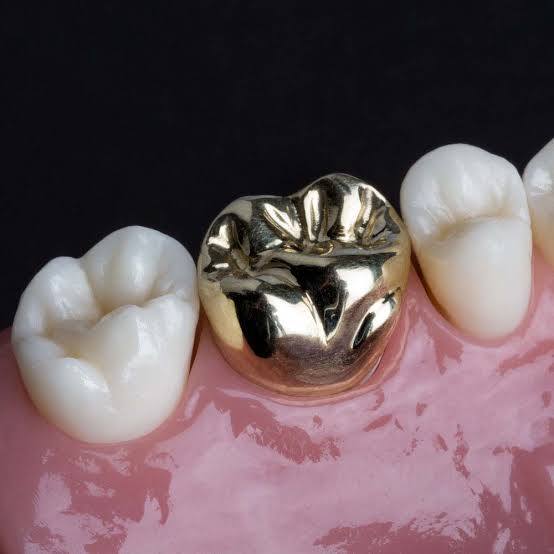 molar-tooth-crown